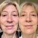 Маска LED Light Therapy Face Mask: Series 2 SP-454 фото 6